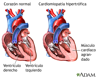 corazon con cardiomiopatia hipertrofica