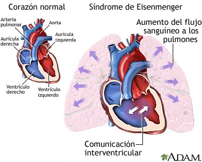 qué ocurre cuando una persona tiene Sindrome de Eisenmenger