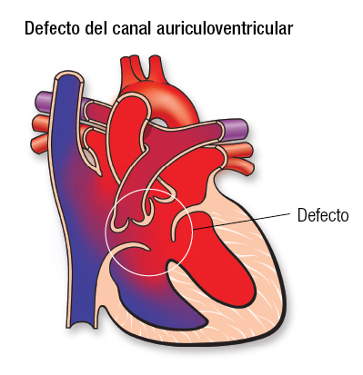 la comunicacion auriculoventricular es una de las cardiopatias congenitas mas complejas