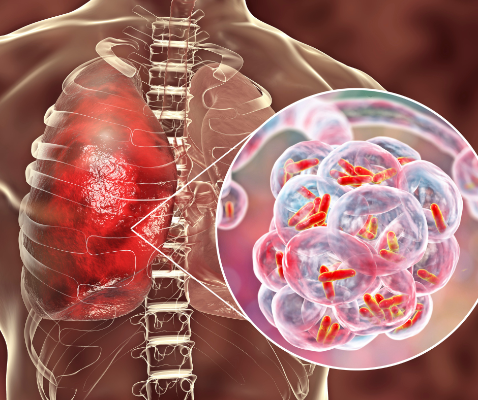 Endocarditis bacteriana